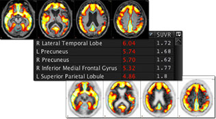 Amyloid