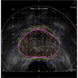 Brachy_Prostate image